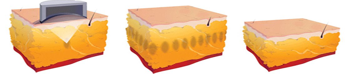 Aparelho de emagrecimento Liposonix