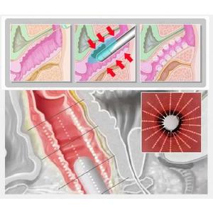   Máquina para estreitamento vaginal 